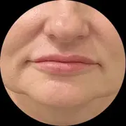 Sagging Jawline