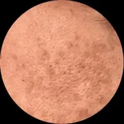 Sun Damage